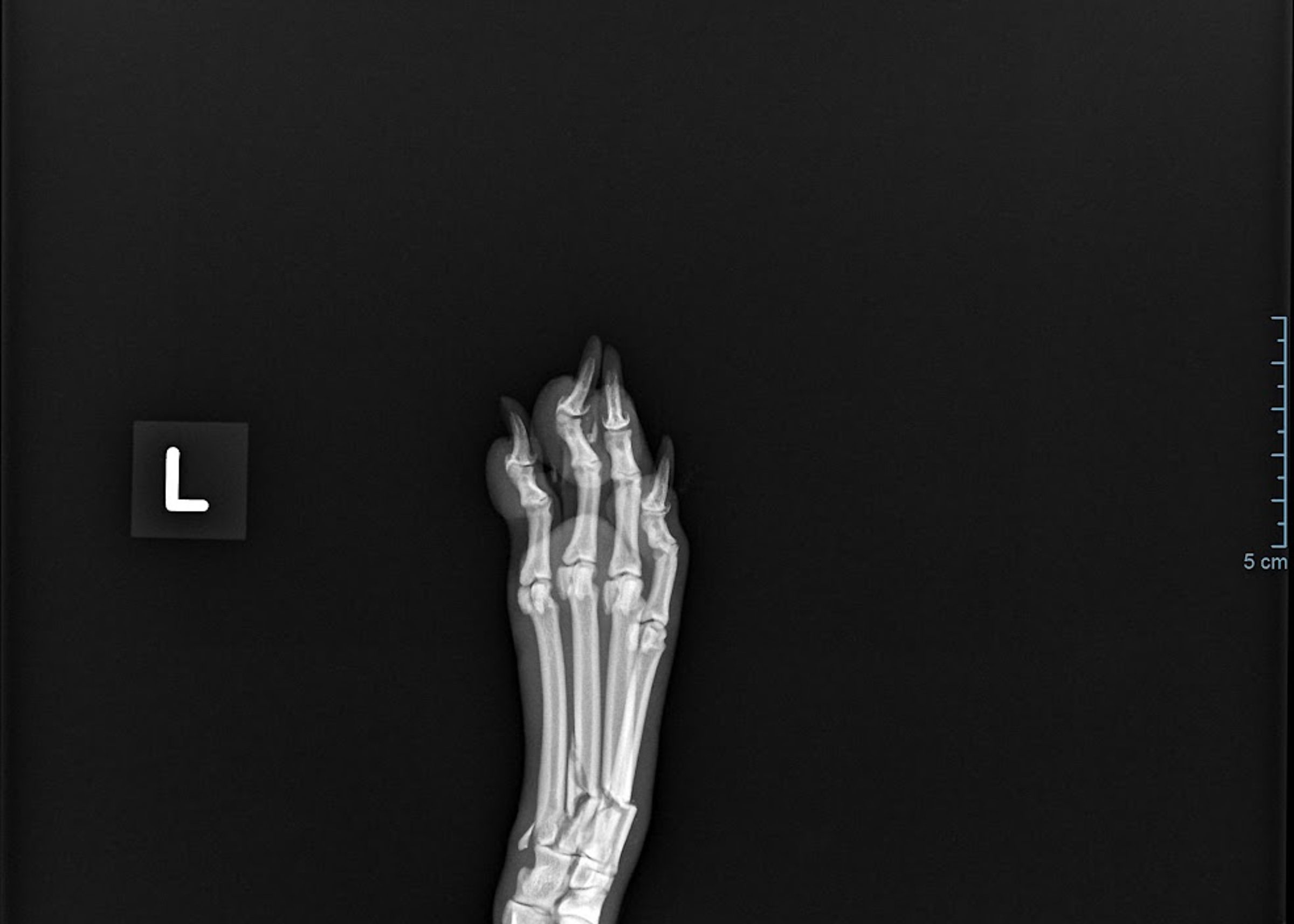 metatarsal fracture radiograph (1 of 1)